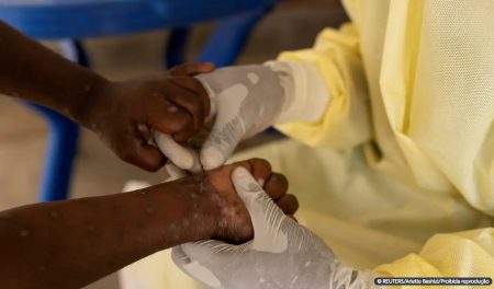 Saúde negocia compra de 25 mil doses de vacina contra mpox 8